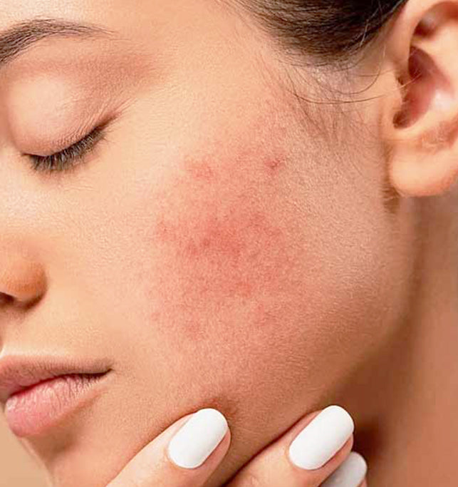 Removing Acne From Your Face