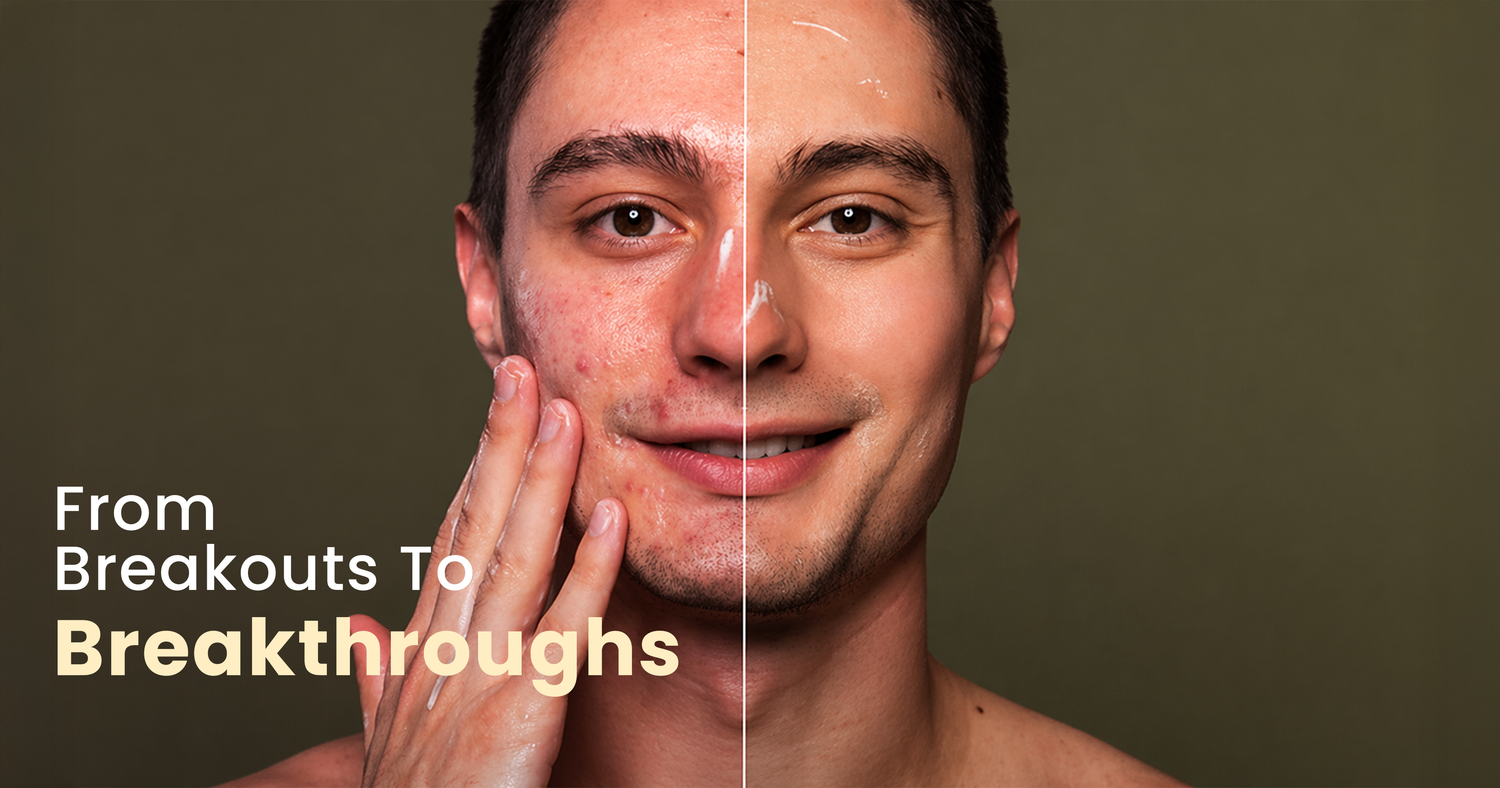 acne treatments