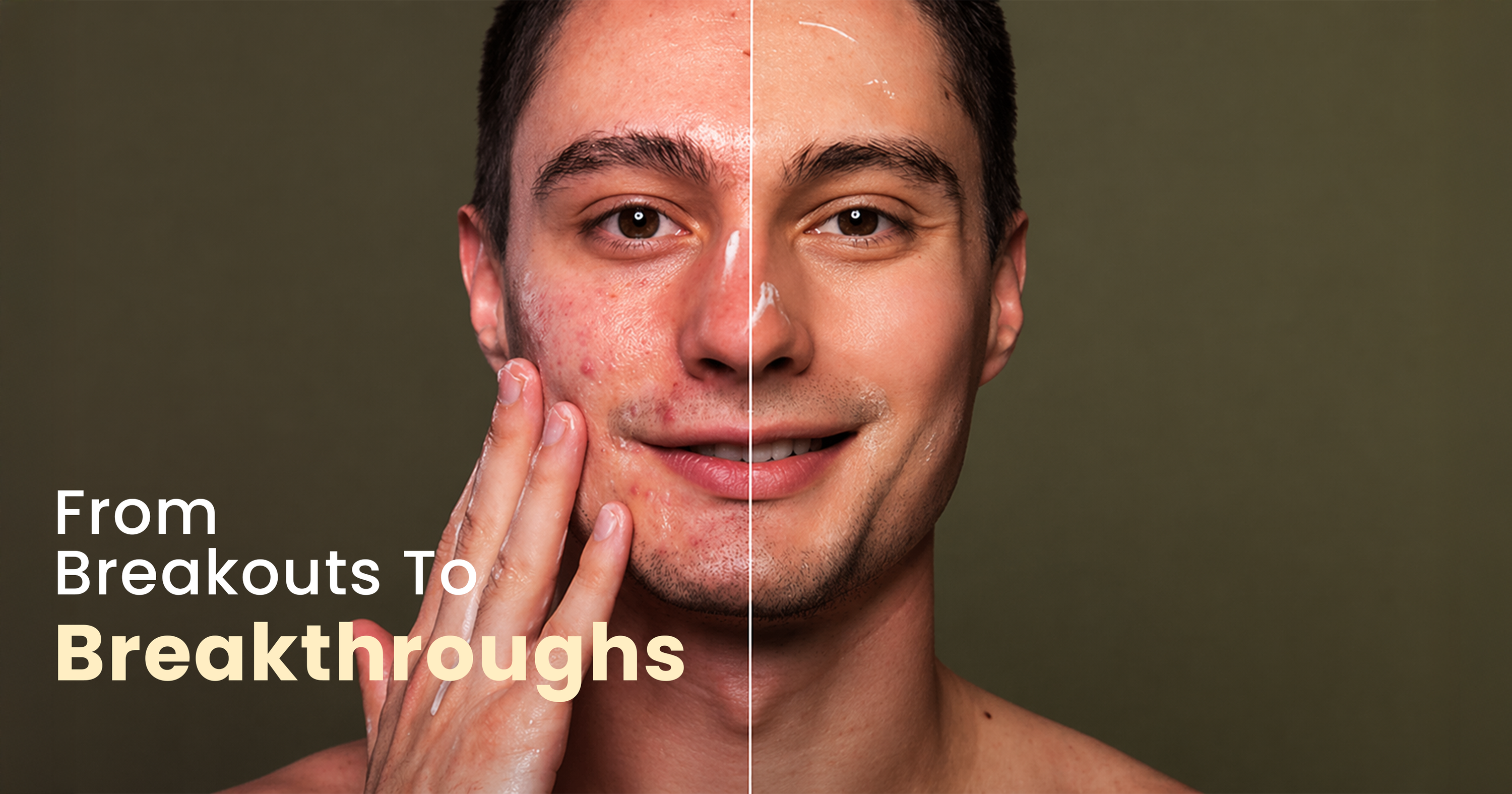 acne treatments