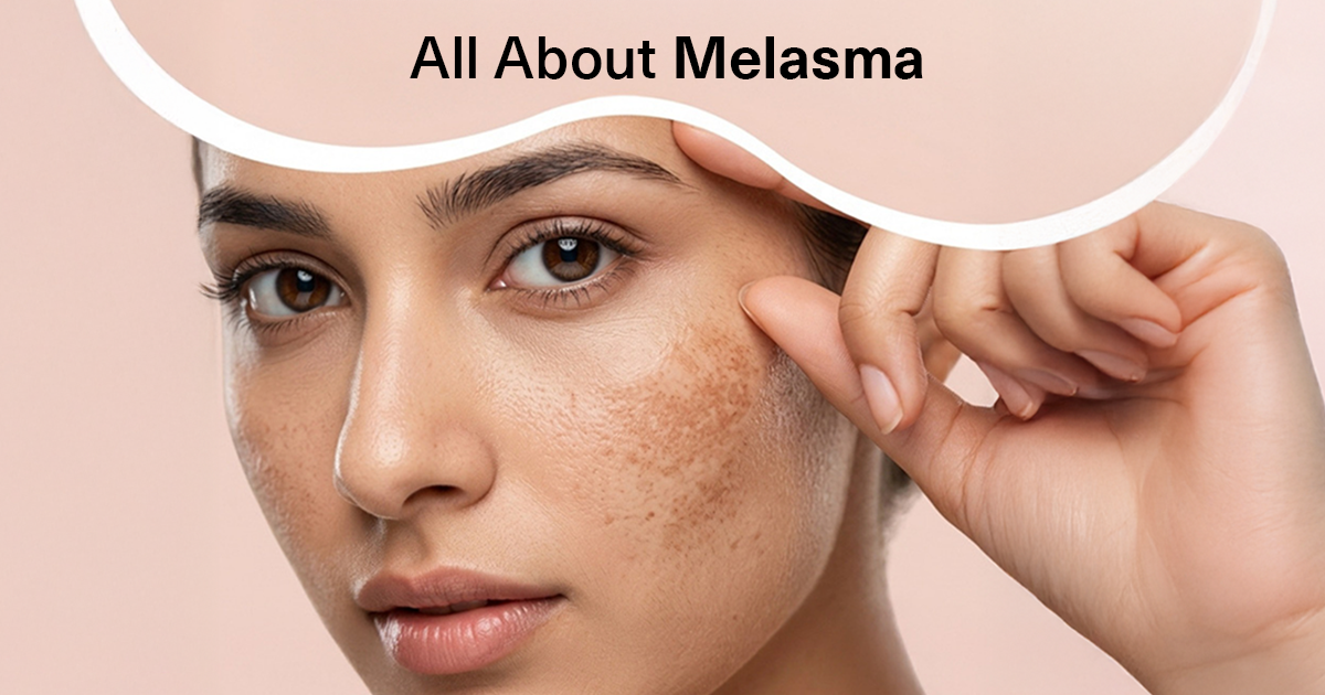 Melasma Treatment for Face