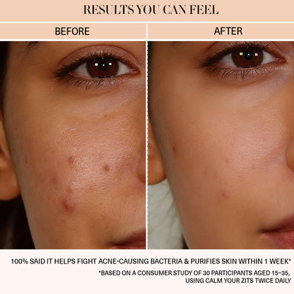 Calm Your Zits - Anti-Acne Gel